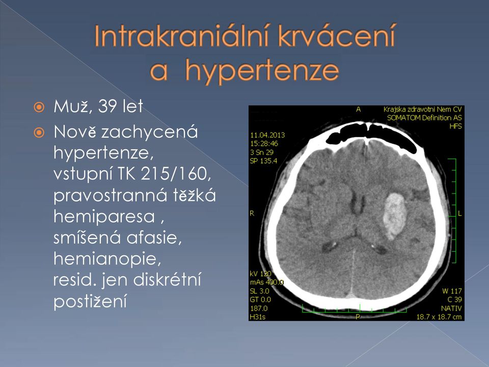 TK 215/160, pravostranná t ká