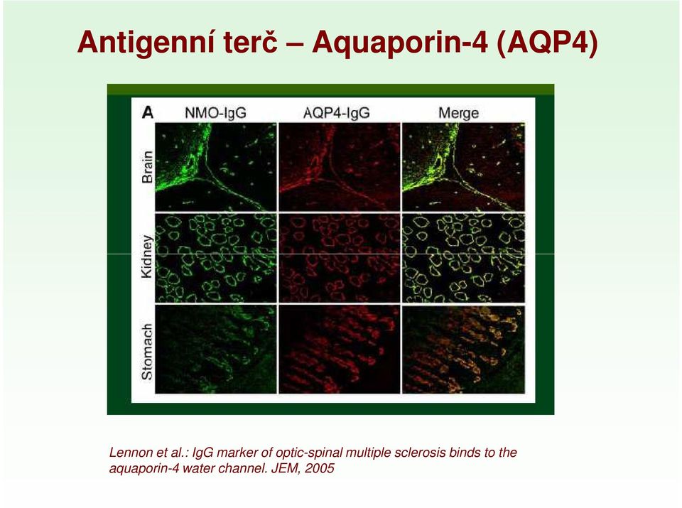 : IgG marker of optic-spinal