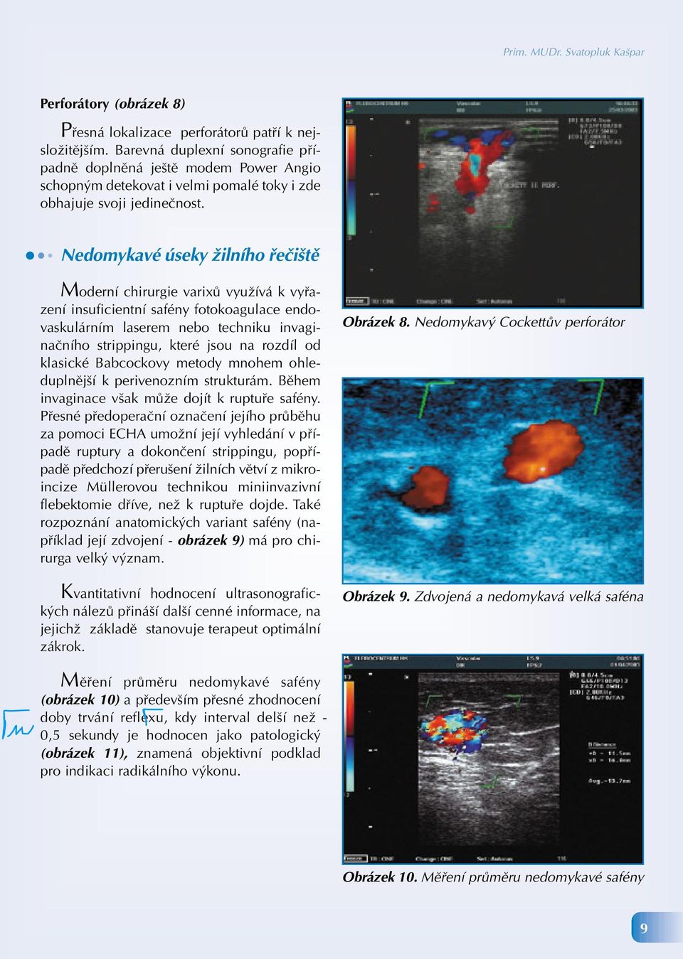 Nedomykavé úseky žilního řečiště Moderní chirurgie varixů využívá k vyřazení insuficientní safény fotokoagulace endovaskulárním laserem nebo techniku invaginačního strippingu, které jsou na rozdíl od