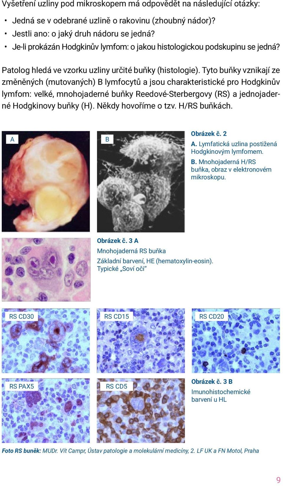 Tyto buňky vznikají ze změněných (mutovaných) B lymfocytů a jsou charakteristické pro Hodgkinův lymfom: velké, mnohojaderné buňky Reedové-Sterbergovy (RS) a jednojaderné Hodgkinovy buňky (H).