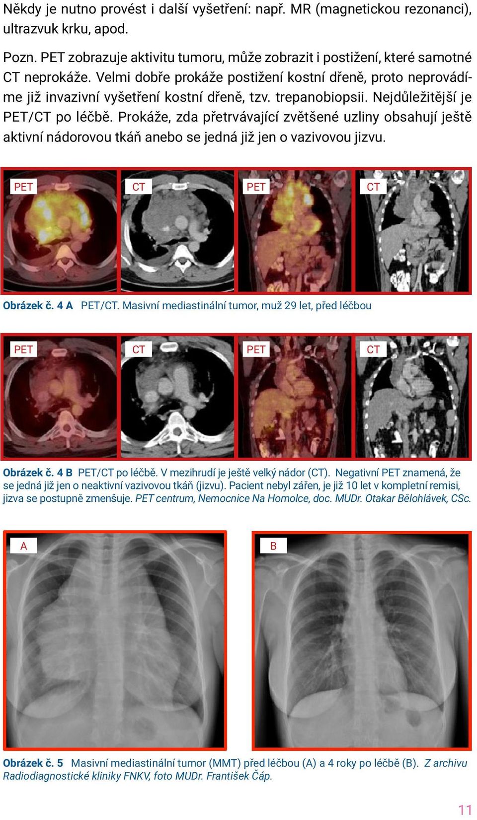 Prokáže, zda přetrvávající zvětšené uzliny obsahují ještě aktivní nádorovou tkáň anebo se jedná již jen o vazivovou jizvu. PET CT PET CT Obrázek č. 4 A PET/CT.