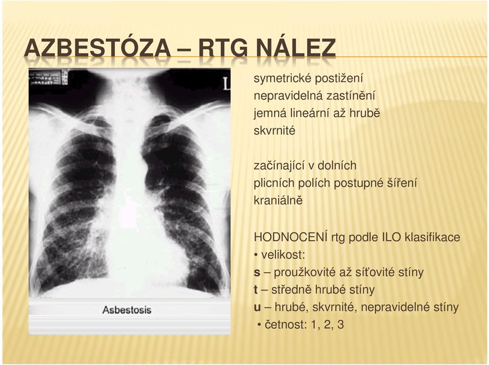 kraniálně HODNOCENÍ rtg podle ILO klasifikace velikost: s proužkovité až