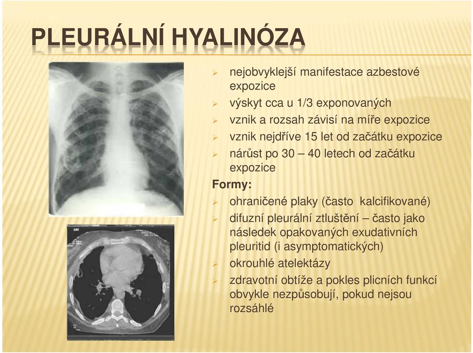 ohraničené plaky (často kalcifikované) difuzní pleurální ztluštění často jako následek opakovaných exudativních