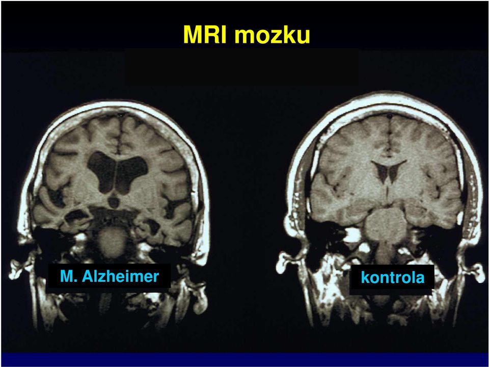 Alzheimer