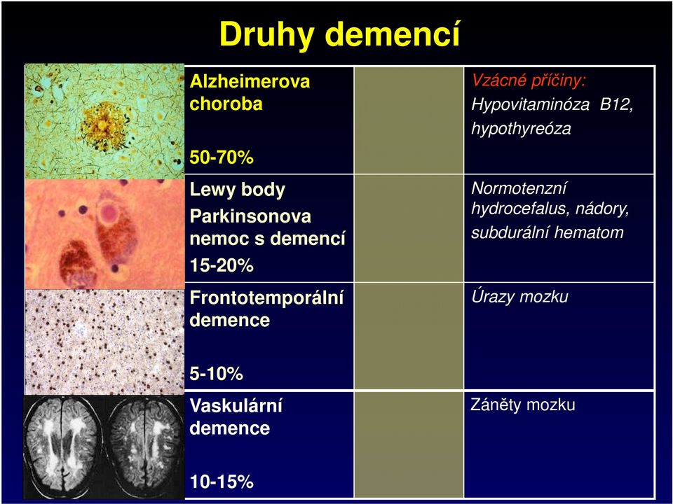 Frontotemporální demence Vzácné příčiny: Hypovitaminóza B12, hypothyreóza