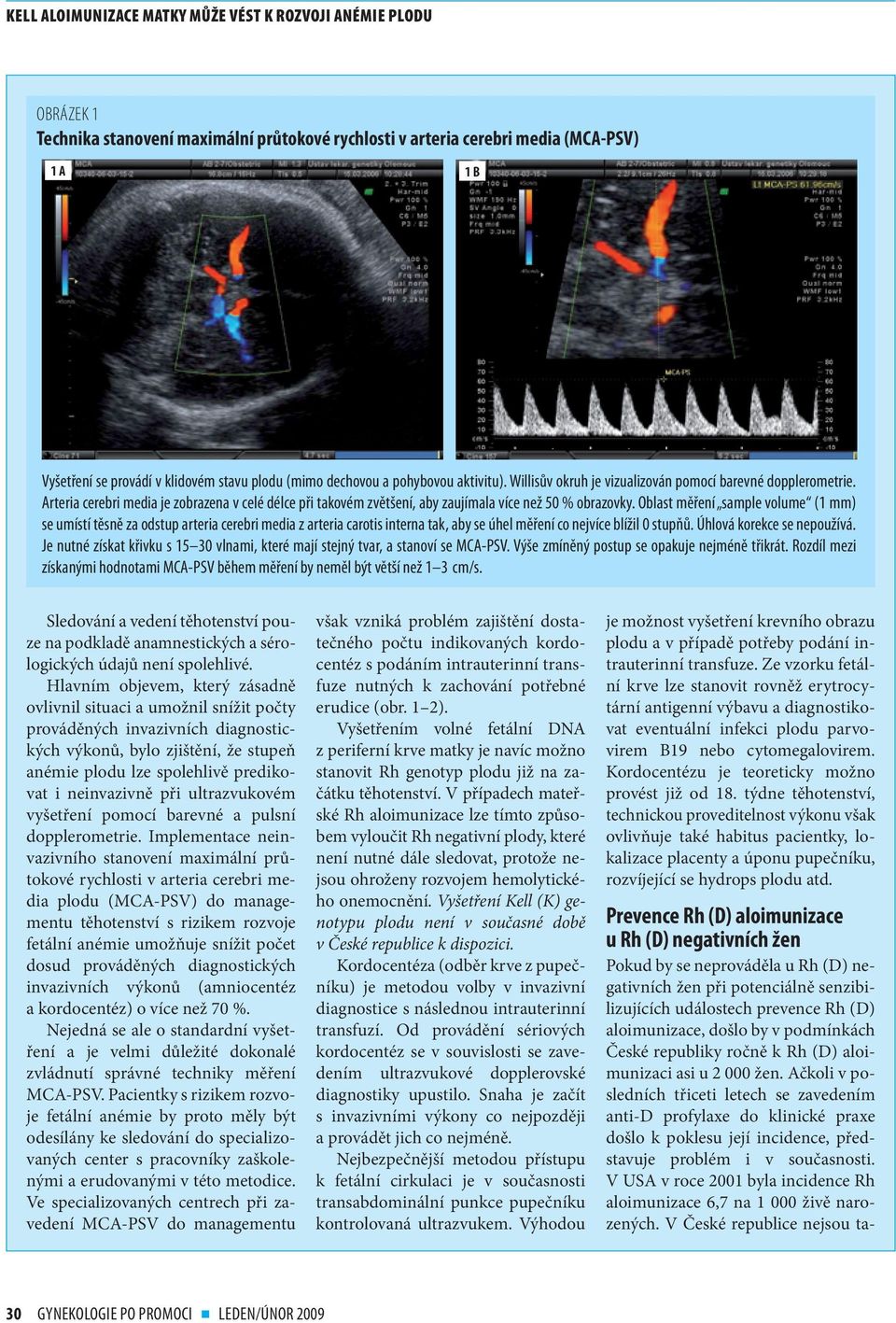 Oblast měření sample volume (1 mm) se umístí těsně za odstup arteria cerebri media z arteria carotis interna tak, aby se úhel měření co nejvíce blížil 0 stupňů. Úhlová korekce se nepoužívá.