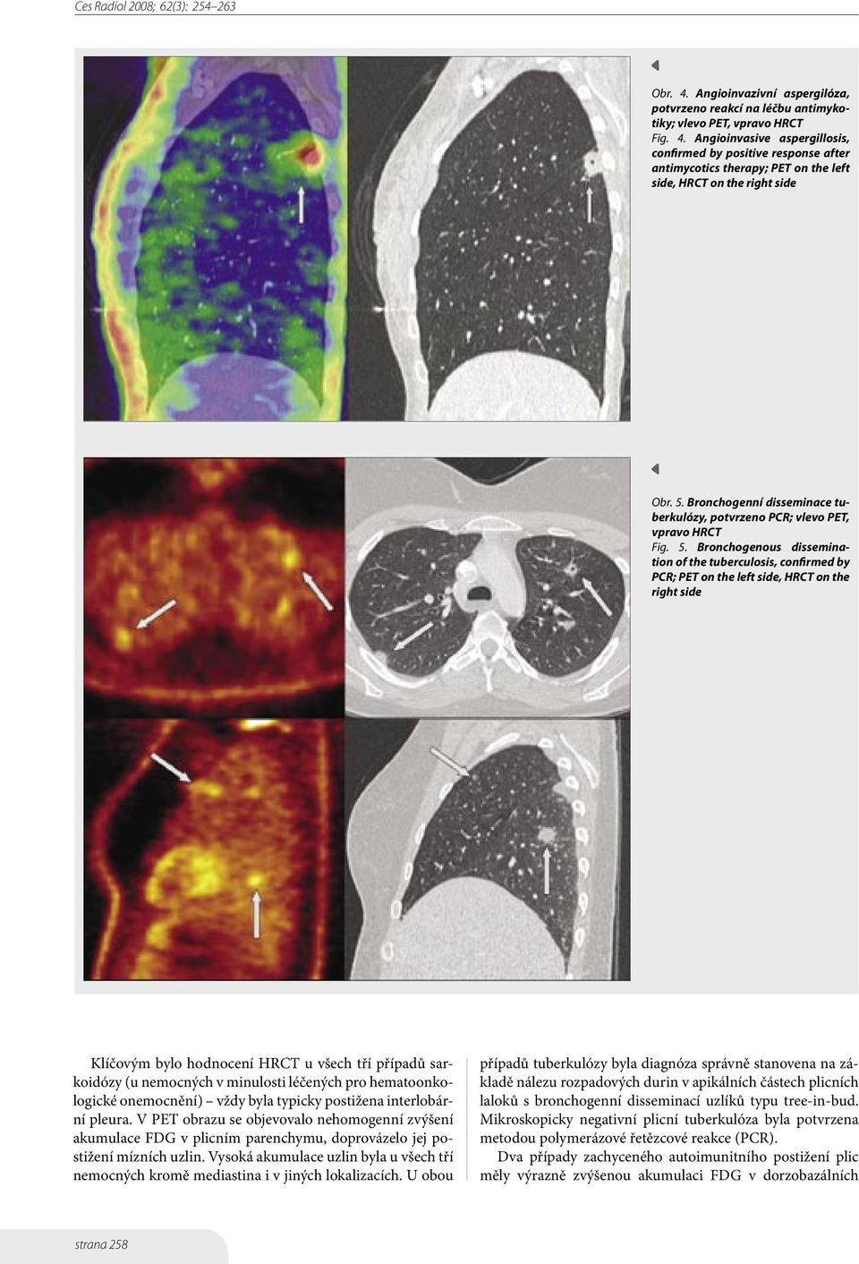 Bronchogenous dissemination of the tuberculosis, confirmed by PCR; PET on the left side, HRCT on the right side Klíčovým bylo hodnocení HRCT u všech tří případů sarkoidózy (u nemocných v minulosti