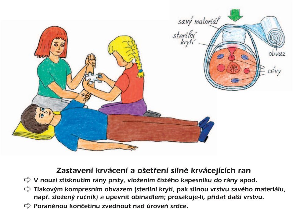 Tlakovým kompresním obvazem (sterilní krytí, pak silnou vrstvu savého materiálu,