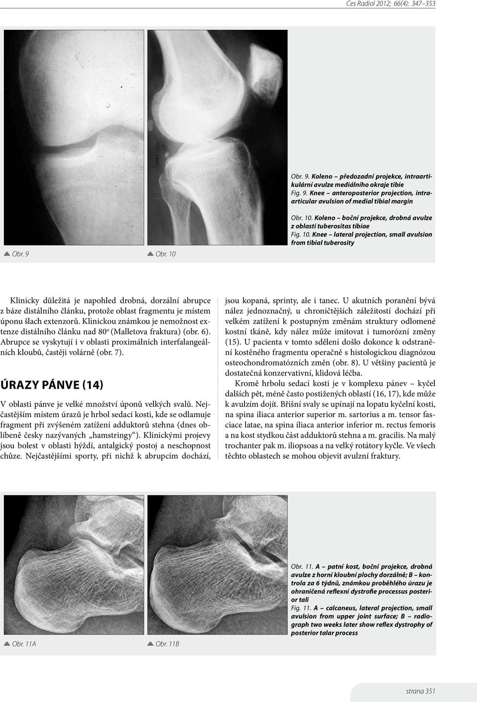 Koleno boční projekce, drobná avulze z oblasti tuberositas tibiae Fig. 10.