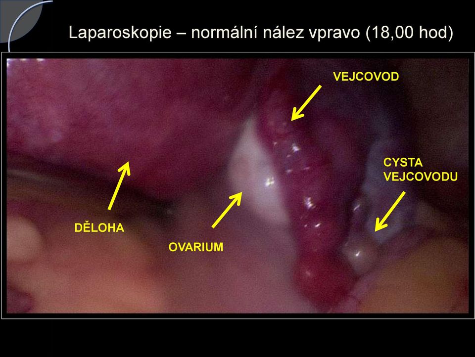 hod) VEJCOVOD CYSTA