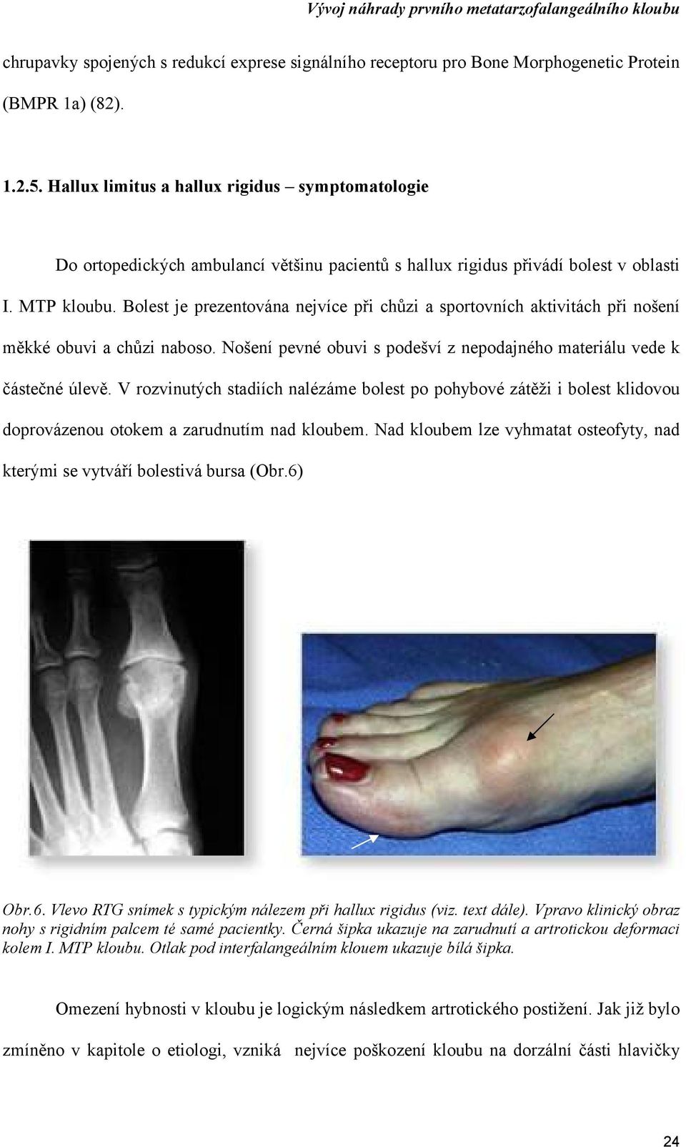 Bolest je prezentována nejvíce při chůzi a sportovních aktivitách při nošení měkké obuvi a chůzi naboso. Nošení pevné obuvi s podešví z nepodajného materiálu vede k částečné úlevě.
