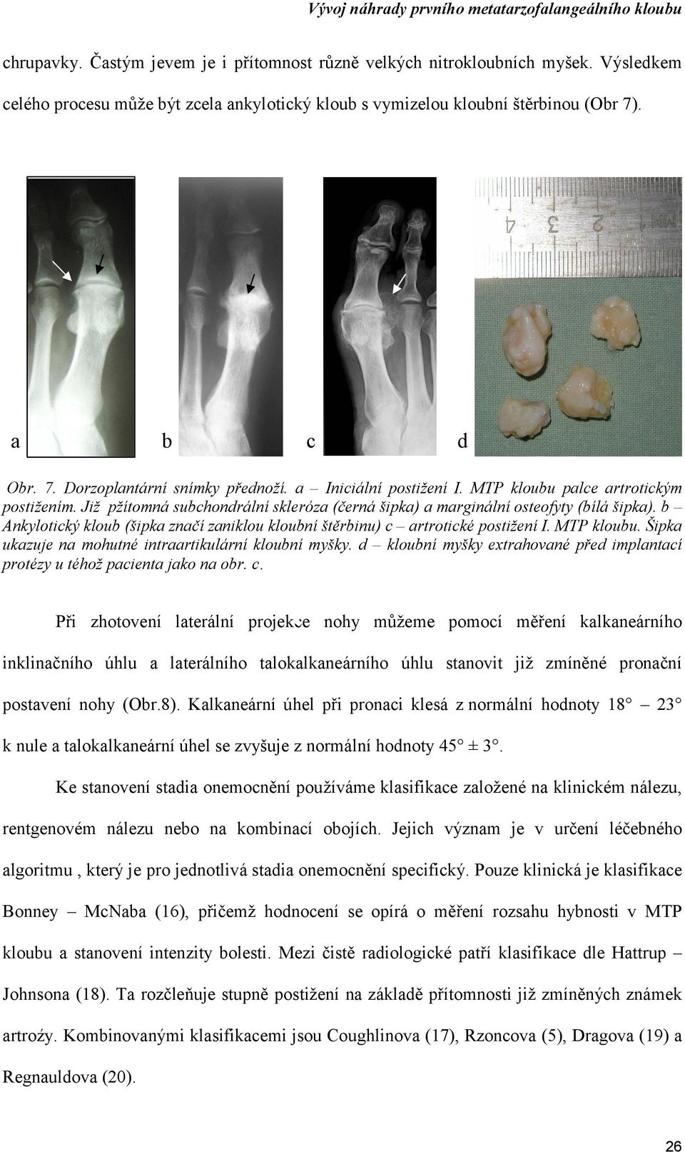 Již pžítomná subchondrální skleróza (černá šipka) a marginální osteofyty (bílá šipka). b Ankylotický kloub (šipka značí zaniklou kloubní štěrbinu) c artrotické postižení I. MTP kloubu.