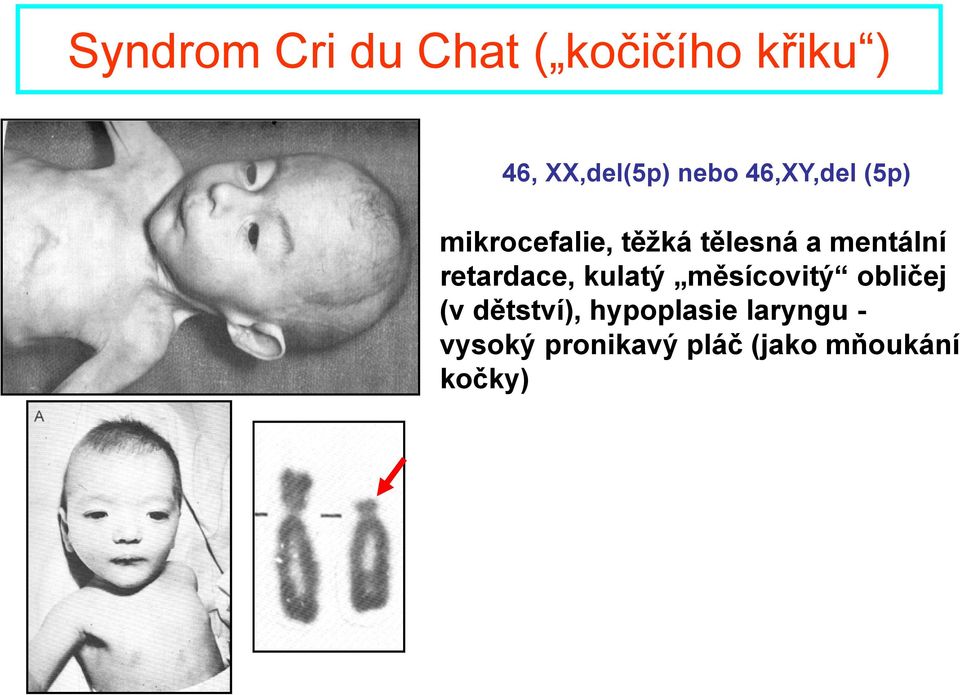 mentální retardace, kulatý měsícovitý obličej (v