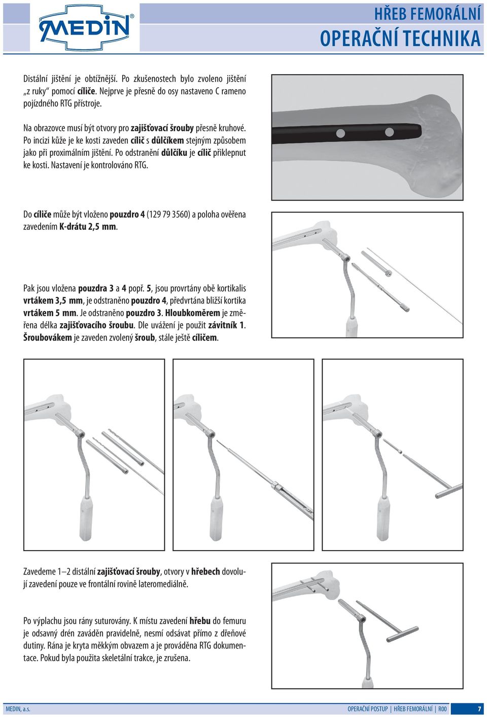 Po odstranění důlčíku je cílič přiklepnut ke kosti. Nastavení je kontrolováno RTG. Do cíliče může být vloženo pouzdro 4 (129 79 3560) a poloha ověřena zavedením K-drátu 2,5 mm.