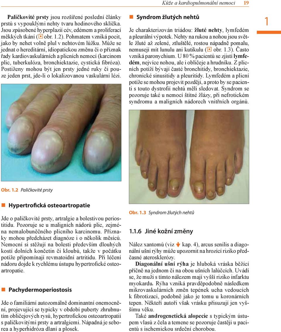 Může se jednat o hereditární, idiopatickou změnu či o příznak řady kardiovaskulárních a plicních nemocí (karcinom plic, tuberkulóza, bronchiektazie, cystická fibróza).