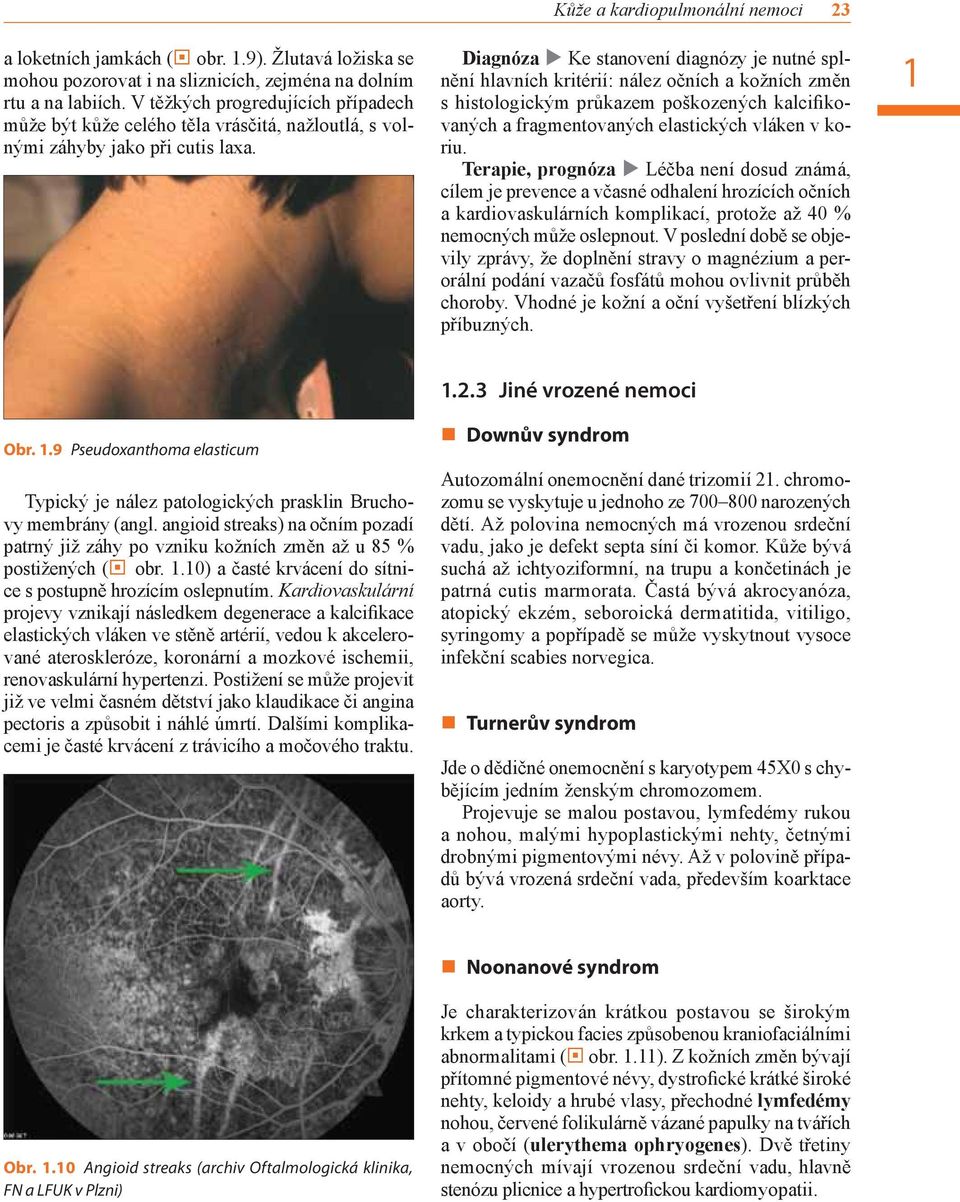 Kůže a kardiopulmonální nemoci 23 Diagnóza Ke stanovení diagnózy je nutné splnění hlavních kritérií: nález očních a kožních změn s histologickým průkazem poškozených kalcifikovaných a fragmentovaných