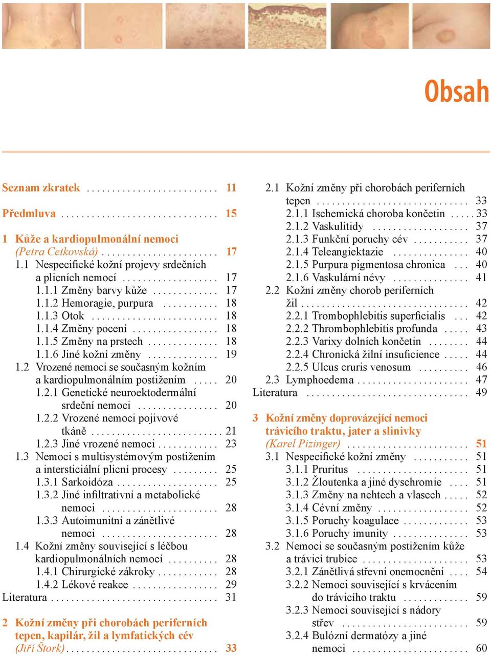 .. 20 1.2.2 Vrozené nemoci pojivové tkáně... 21 1.2.3 Jiné vrozené nemoci... 23 1.3 Nemoci s multisystémovým postižením a intersticiální plicní procesy... 25 1.3.1 Sarkoidóza... 25 1.3.2 Jiné infiltrativní a metabolické nemoci.