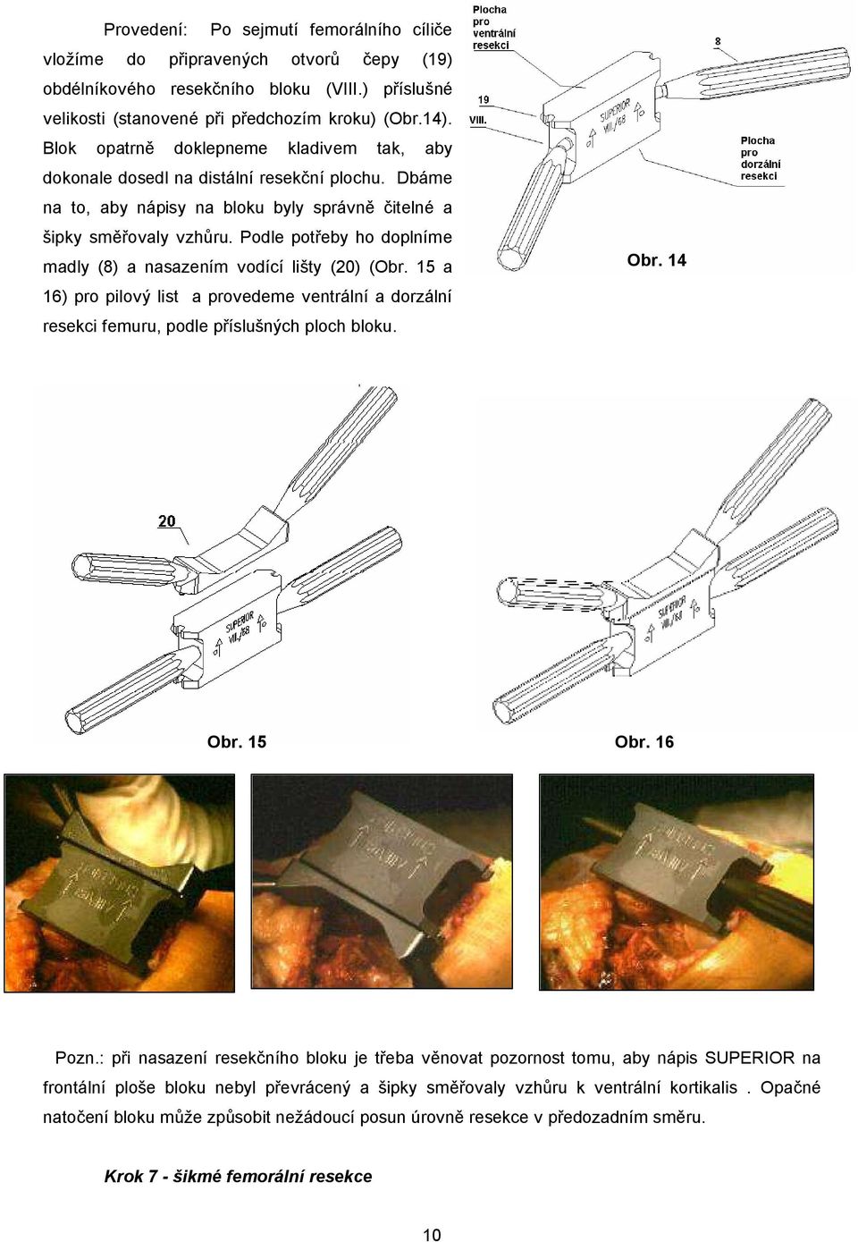 Podle potřeby ho doplníme madly (8) a nasazením vodící lišty (20) (Obr. 15 a 16) pro pilový list a provedeme ventrální a dorzální resekci femuru, podle příslušných ploch bloku. Obr. 14 Obr. 15 Obr.