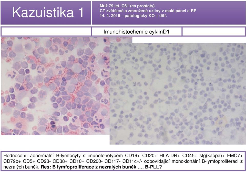 Imunohistochemie cyklind1 Hodnocení: abnormální B-lymfocyty s imunofenotypem CD19+ CD20+ HLA-DR+ CD45+