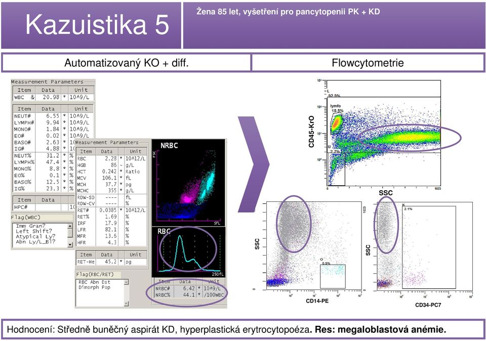 CD45-KrO CD14-PE CD34-PC7 Hodnocení: Středně buněčný