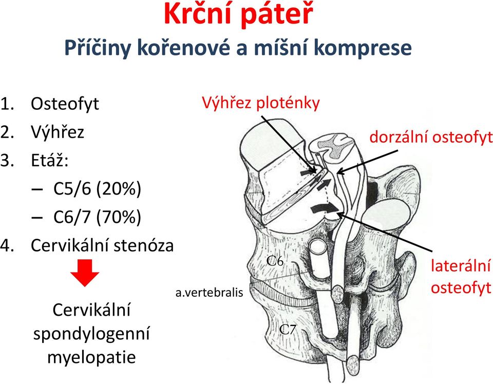 Cervikální stenóza Cervikální spondylogenní myelopatie