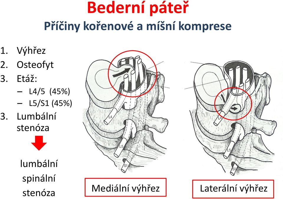 Etáž: L4/5 (45%) L5/S1 (45%) 3.