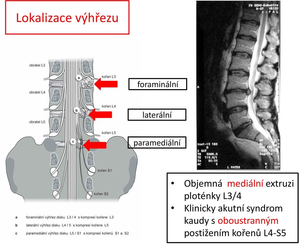 ploténky L3/4 Klinicky akutní syndrom