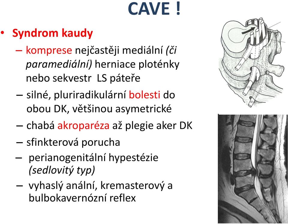 páteře silné, pluriradikulární bolesti do obou DK, většinou asymetrické chabá