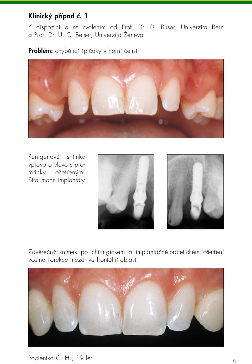 Belser, Univerzita Ženeva Problém: chybějící špičáky v horní čelisti Rentgenové snímky vpravo a