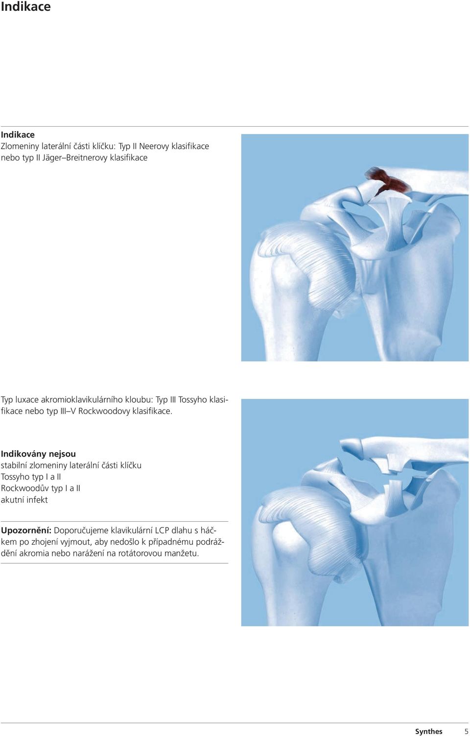 Indikovány nejsou stabilní zlomeniny laterální části klíčku Tossyho typ I a II Rockwoodův typ I a II akutní infekt Upozornění: