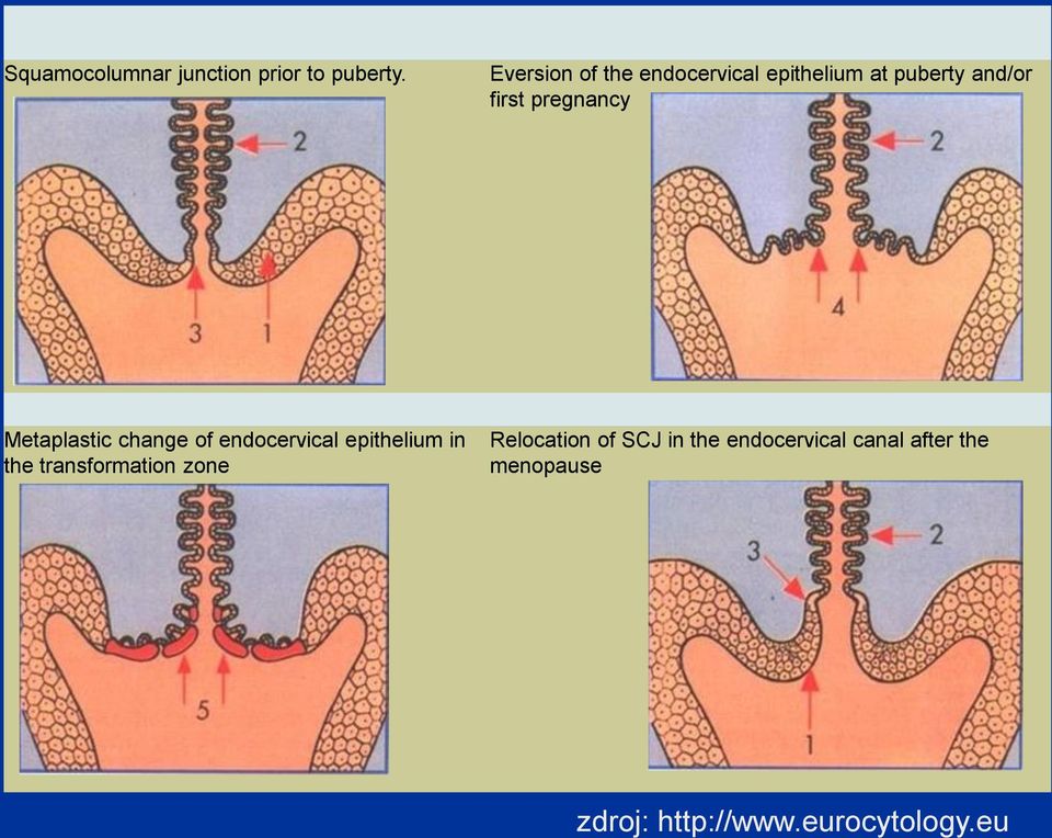 pregnancy Metaplastic change of endocervical epithelium in the