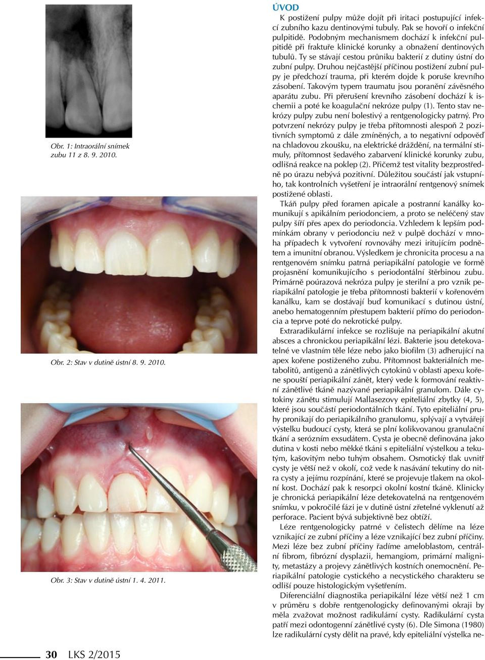 Podobným mechanismem dochází k infekční pulpitidě při fraktuře klinické korunky a obnažení dentinových tubulů. Ty se stávají cestou průniku bakterií z dutiny ústní do zubní pulpy.