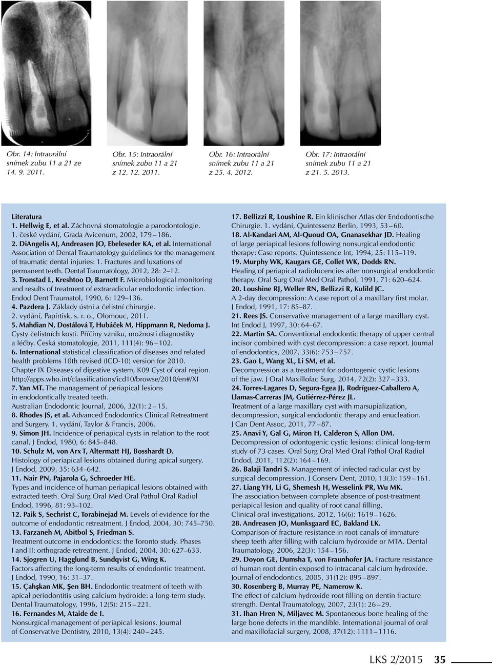 International Association of Dental Traumatology guidelines for the management of traumatic dental injuries: 1. Fractures and luxations of permanent teeth. Dental Traumatology, 2012, 28: 2 12. 3.