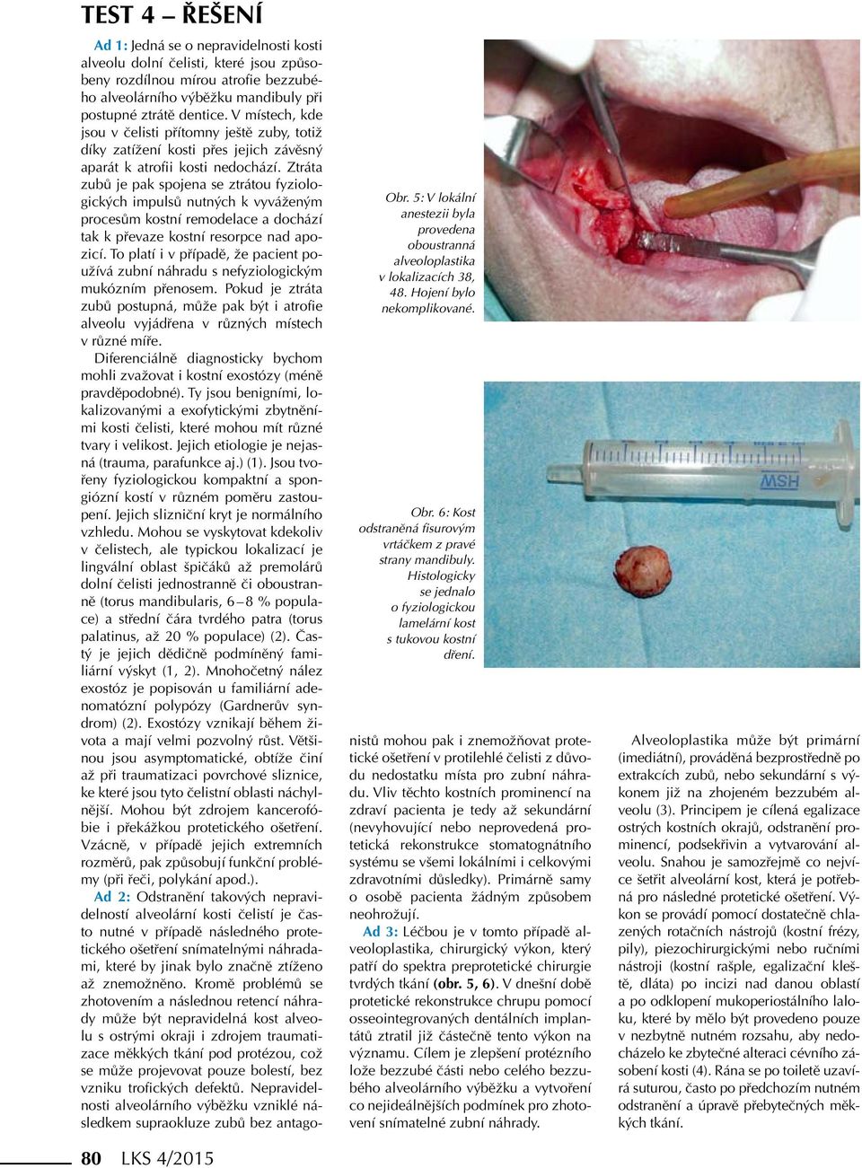 Ad 1: Jedná se o nepravidelnosti kosti alveolu dolní čelisti, které jsou způsobeny rozdílnou mírou atrofie bezzubého alveolárního výběžku mandibuly při postupné ztrátě dentice.
