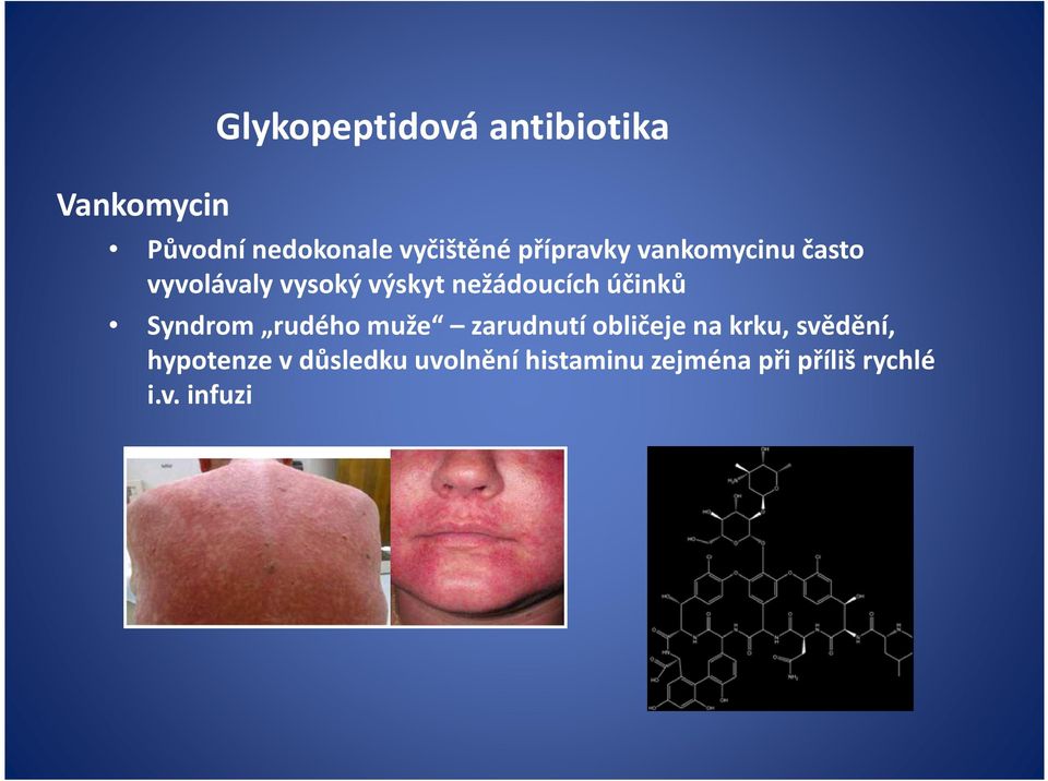 účinků Syndrom rudého muže zarudnutí obličeje na krku, svědění,