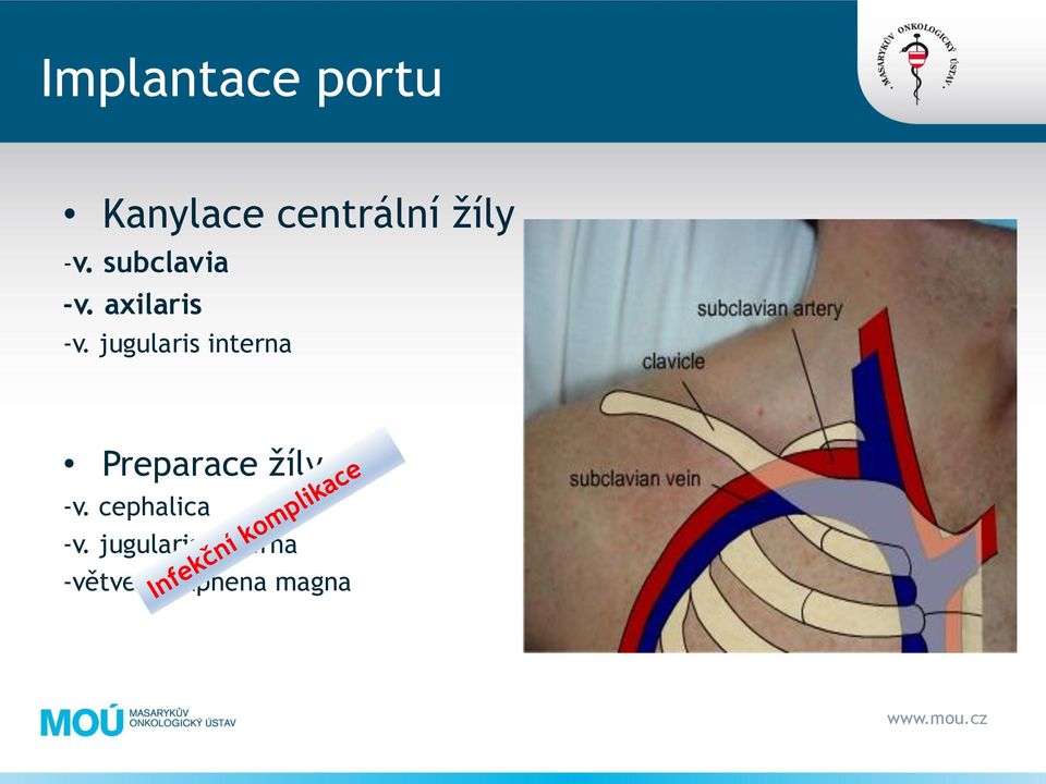 jugularis interna Preparace žíly -v.