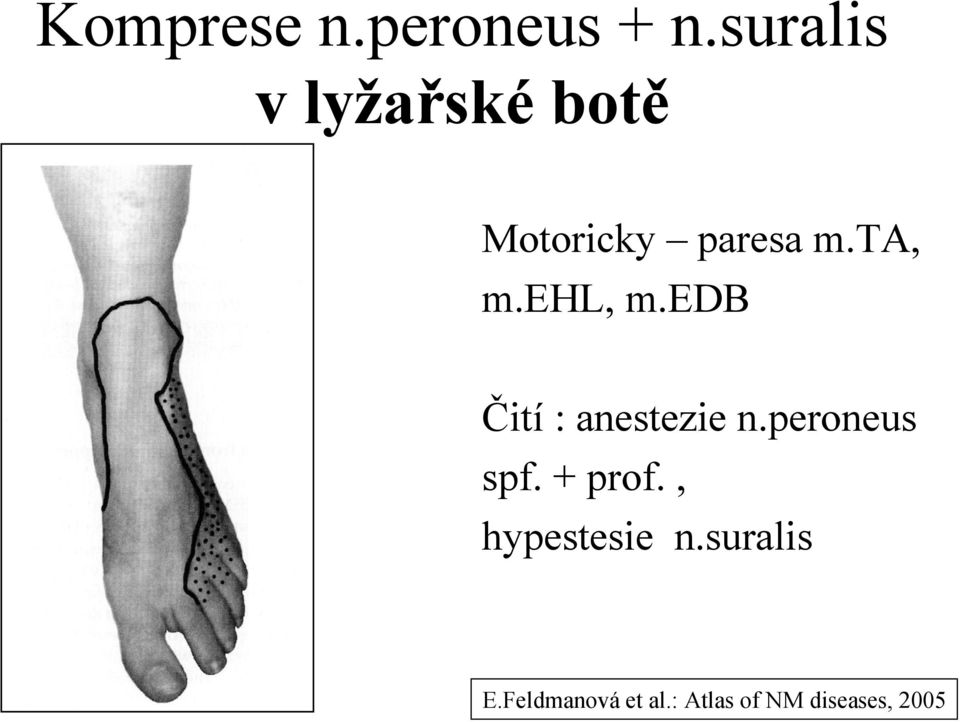 ehl, m.edb Čití : anestezie n.peroneus spf.