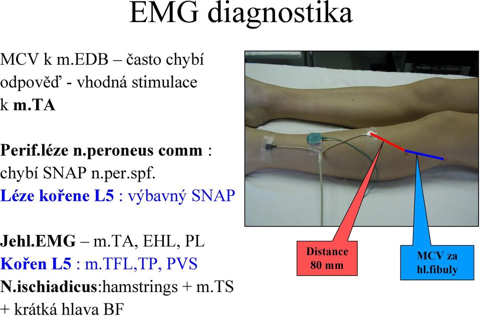 Léze kořene L5 : výbavný SNAP Jehl.EMG m.ta, EHL, PL Kořen L5 : m.