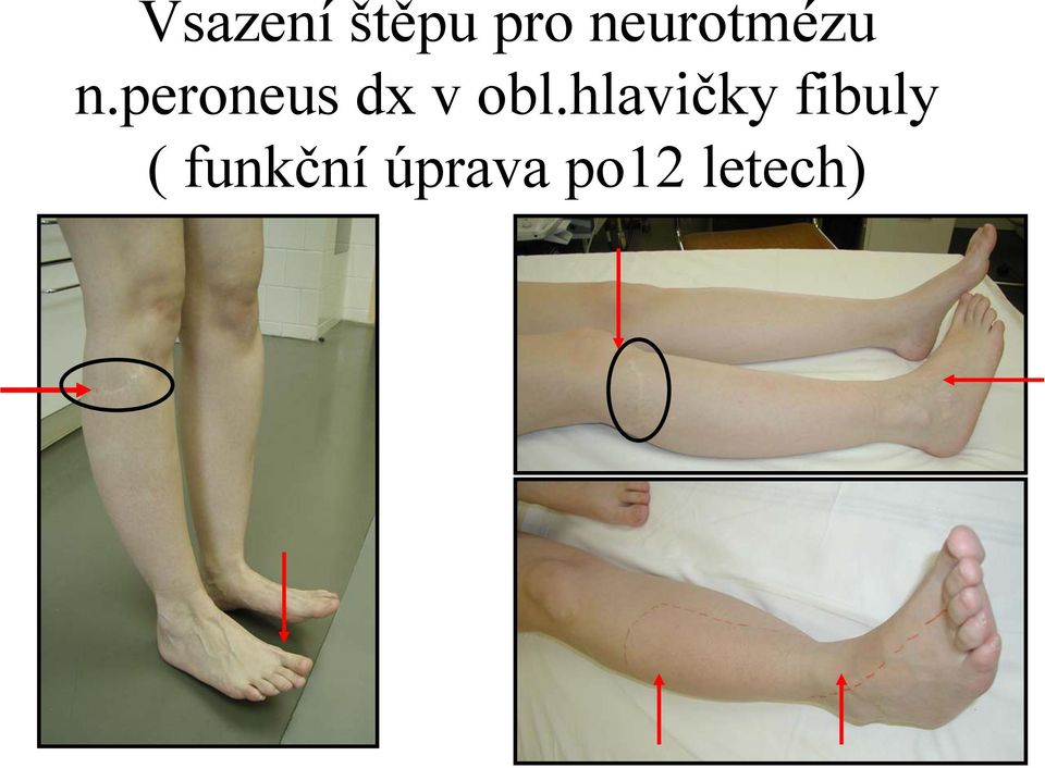 peroneus dx v obl.