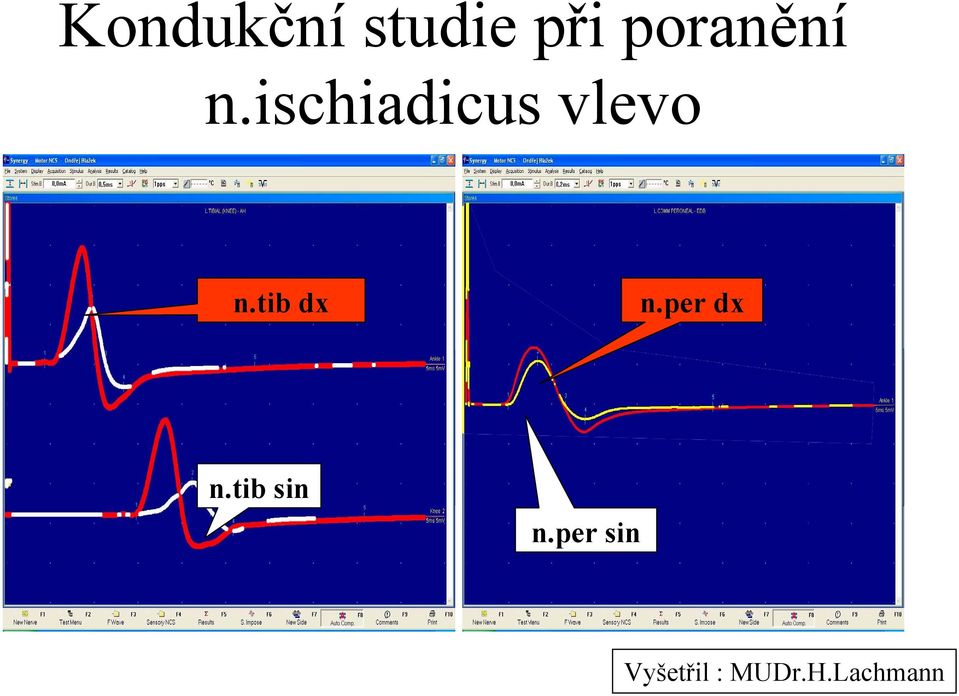 tib dx n.peroneus n.per dx n.