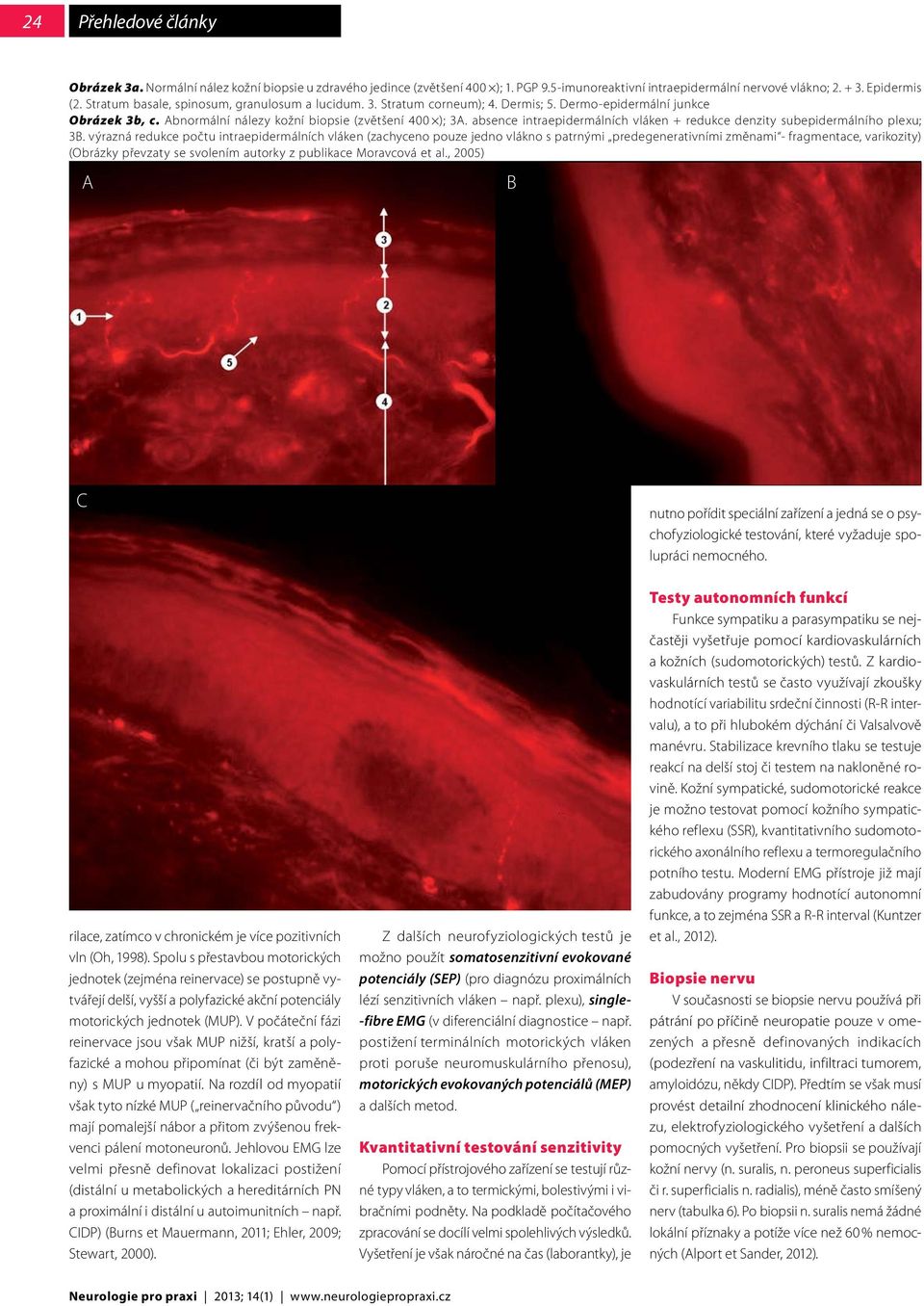 absence intraepidermálních vláken + redukce denzity subepidermálního plexu; 3B.