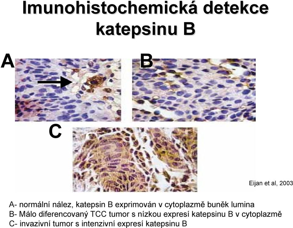 lumina B- Málo diferencovaný TCC tumor s nízkou expresí