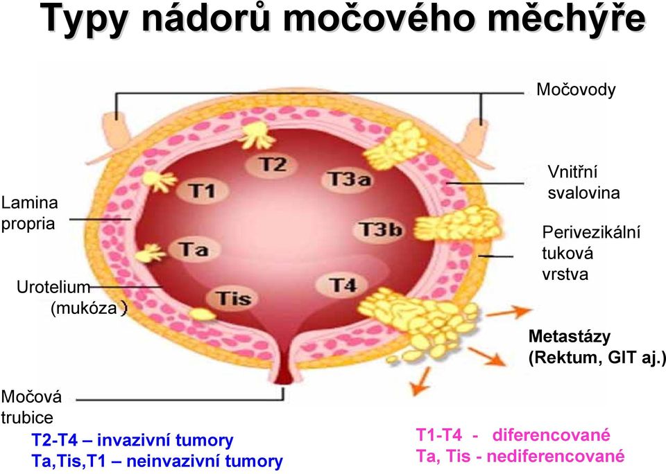 neinvazivní tumory Vnitřní svalovina Perivezikální tuková vrstva