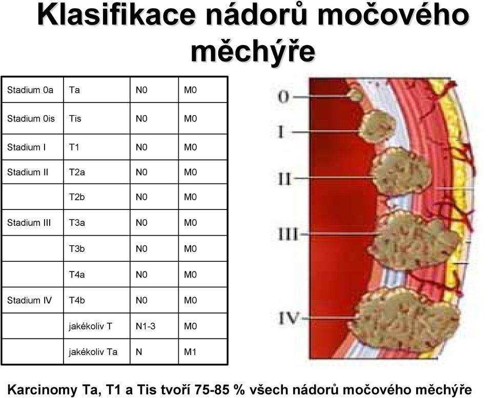 N0 M0 T3b N0 M0 T4a N0 M0 Stadium IV T4b N0 M0 jakékoliv T N1-3 M0