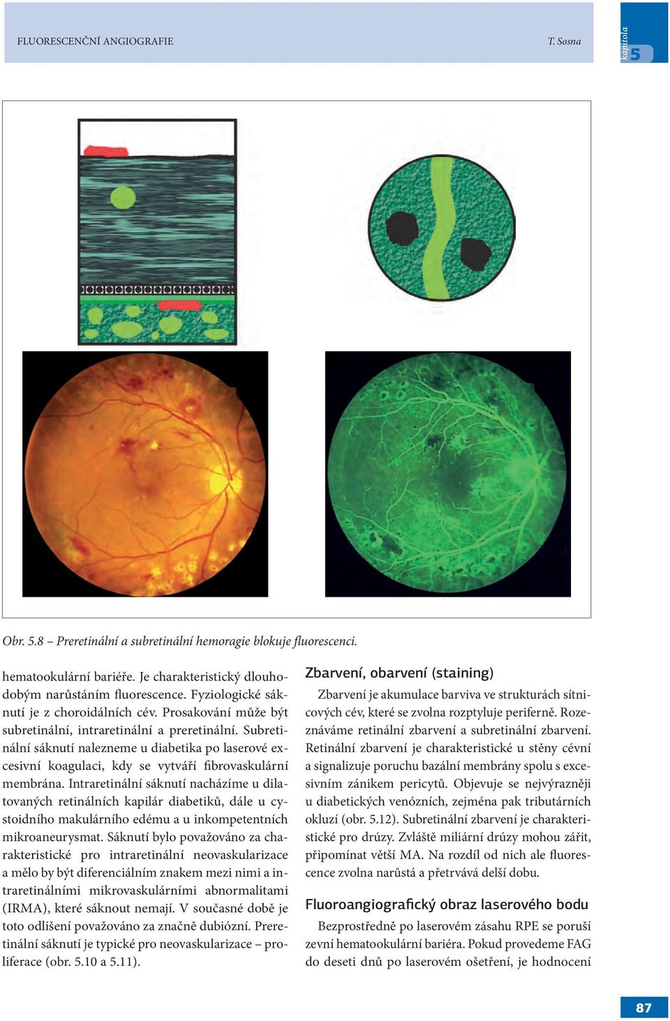 Subretinální sáknutí nalezneme u diabetika po laserové excesivní koagulaci, kdy se vytváří fibrovaskulární membrána.