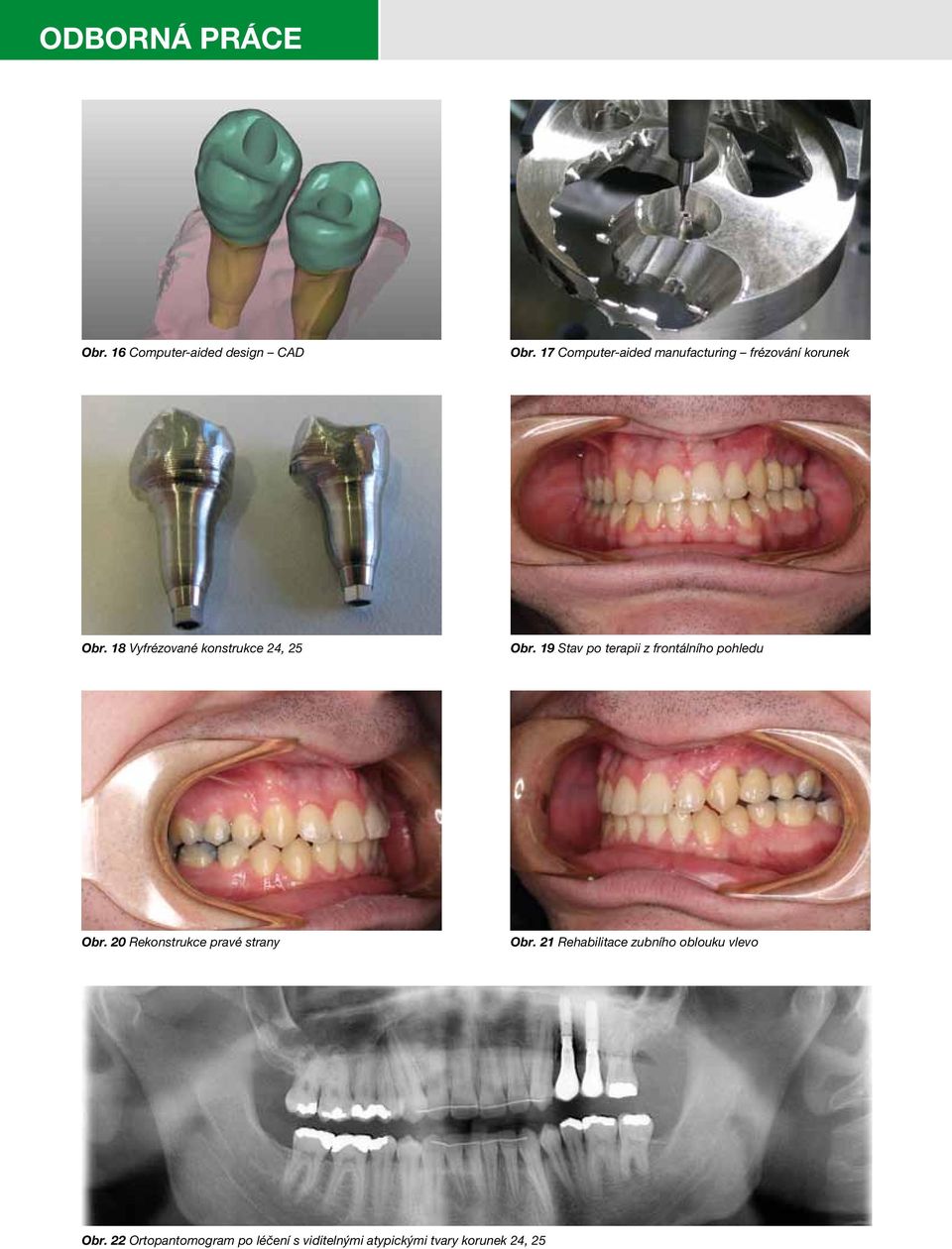 18 Vyfrézované konstrukce 24, 25 Obr. 19 Stav po terapii z frontálního pohledu Obr.