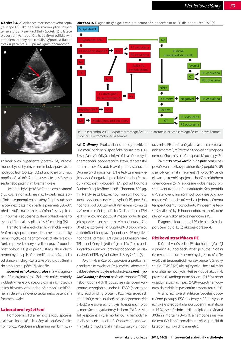 perikardiální výpotek a fluidotorax u pacienta s PE při maligním onemocnění Obrázek 4.