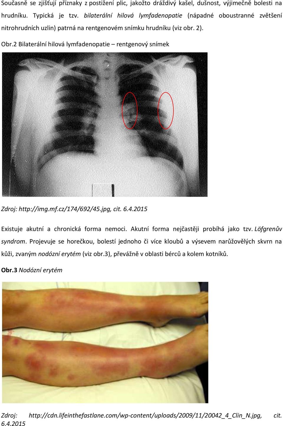 2 Bilaterální hilová lymfadenopatie rentgenový snímek Zdroj: http://img.mf.cz/174/692/45.jpg, cit. 6.4.2015 Existuje akutní a chronická forma nemoci. Akutní forma nejčastěji probíhá jako tzv.