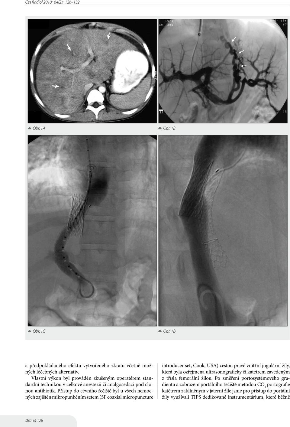 Přístup do cévního řečiště byl u všech nemocných zajištěn mikropunkčním setem (5F coaxial micropuncture introducer set, Cook, USA) cestou pravé vnitřní jugulární žíly, která byla
