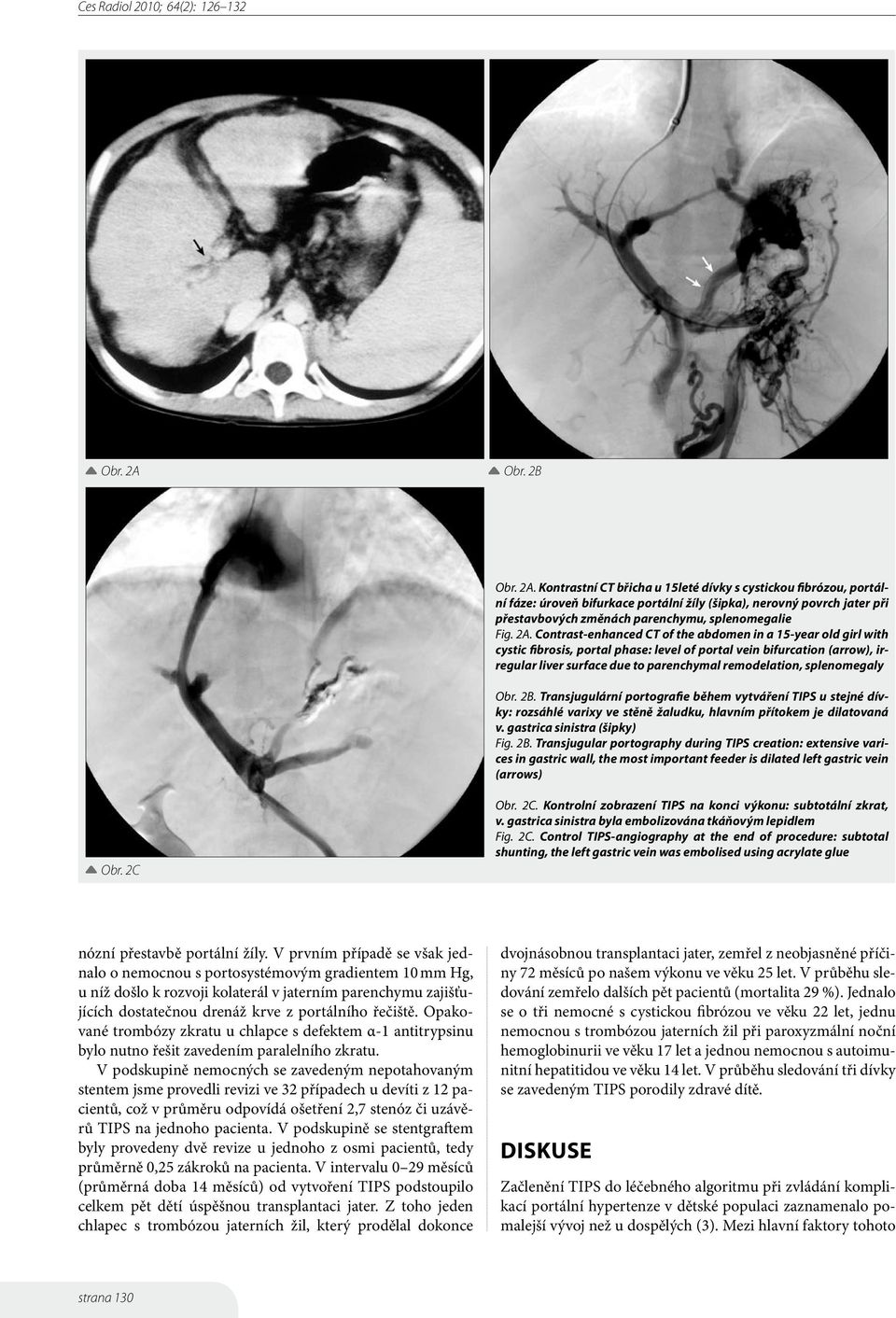 splenomegaly Obr. 2B. Transjugulární portografie během vytváření TIPS u stejné dívky: rozsáhlé varixy ve stěně žaludku, hlavním přítokem je dilatovaná v. gastrica sinistra (šipky) Fig. 2B. Transjugular portography during TIPS creation: extensive varices in gastric wall, the most important feeder is dilated left gastric vein (arrows) Obr.